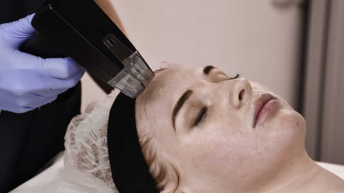 Morpheus8 RF Microneedling being performed