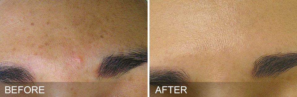 coolsculpting before and after on chin in boca raton
