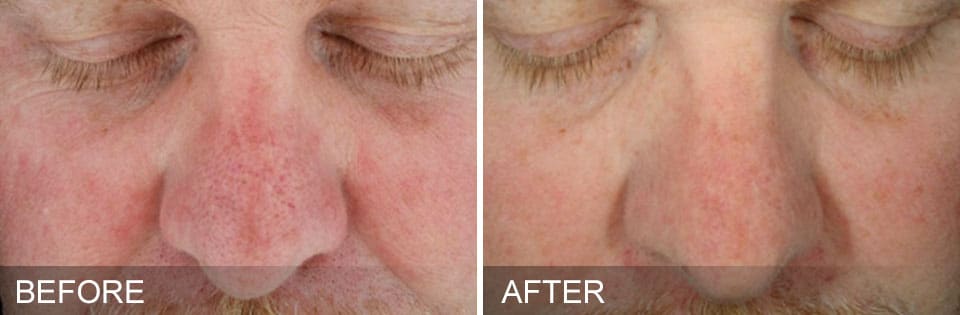 before and after fat freezing on abdomen