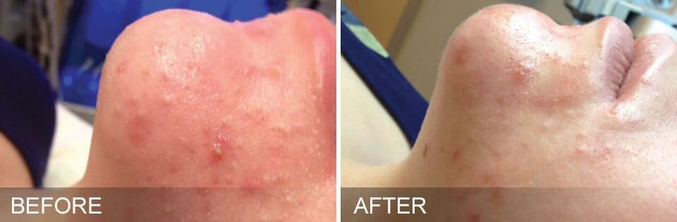 before and after flanks / love handles